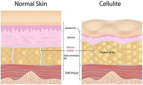 Cellulite Reduction Treatments  The American Board of Cosmetic