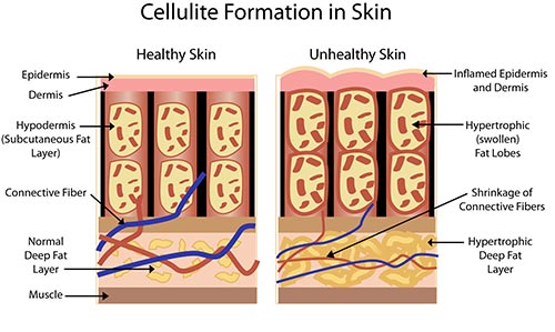 Cellulite Treatment in NYC  Manhattan Dermatology Specialists