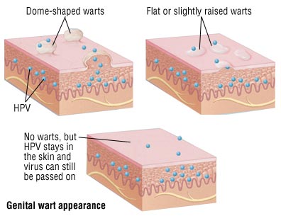 vaginal warts