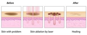 Laser Stretch Mark Removal NYC | Best Laser Treatments for Stretch Marks