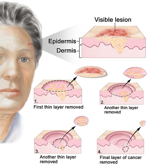 Skin Cancer Treatment