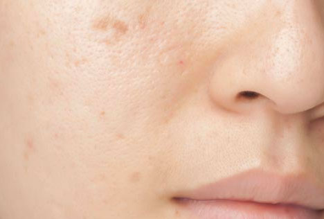 Acne Scars Treatment in NYC  Manhattan Dermatology Specialists